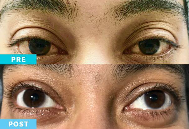 Cómo blanquear el blanco de los ojos