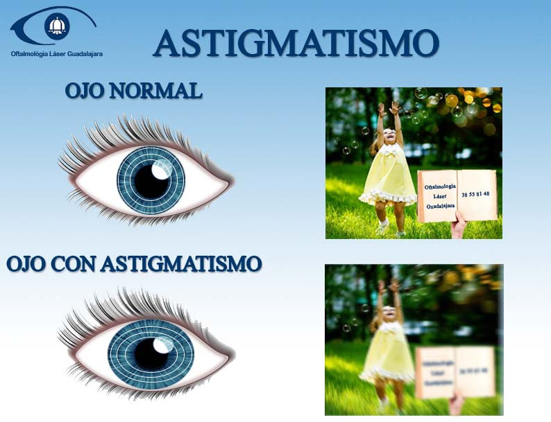 Cómo corregir el astigmatismo