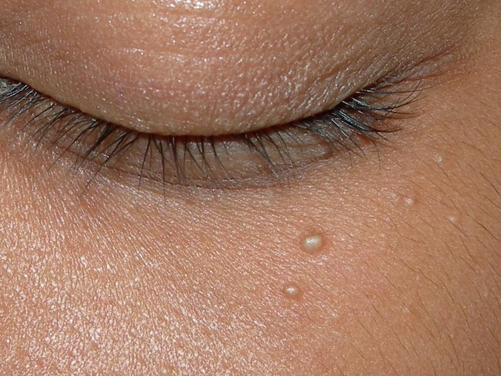 Cómo quitar puntos de grasa en la cara